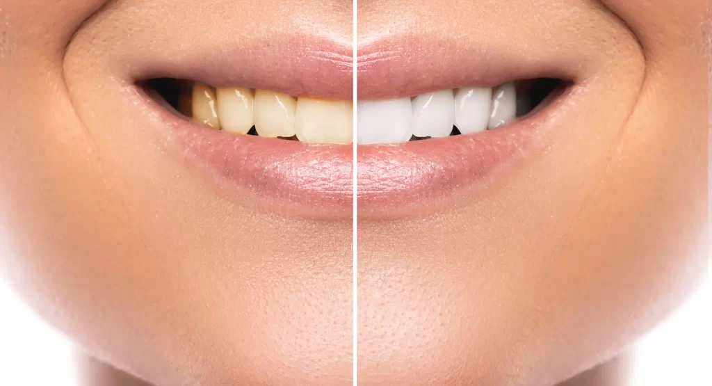 Comparison after teeth whitening.