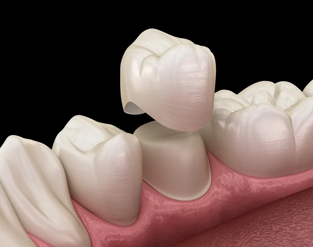 Dental crown process illustration.