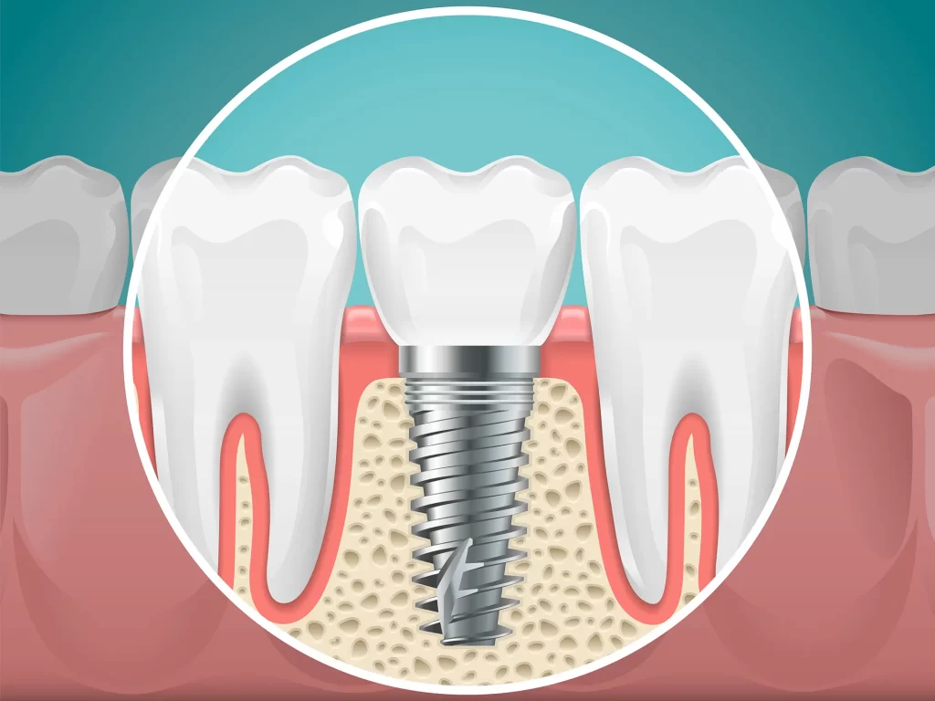 Dental implant illustration.