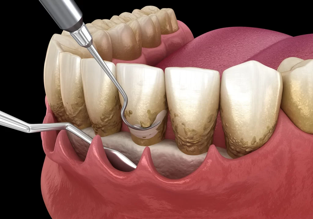Periodontal Disease Treatment illustration.