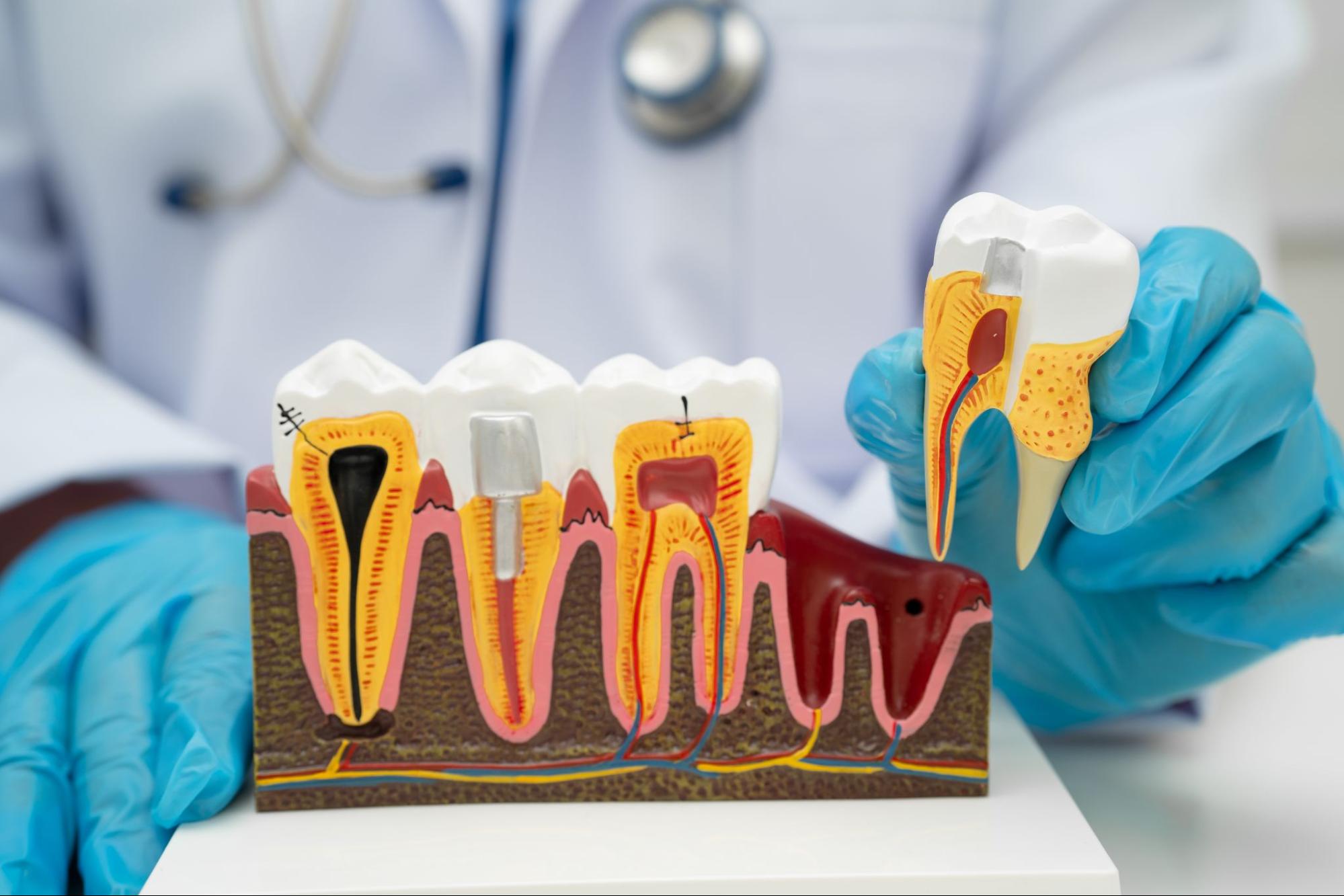 An Asian dentist holds a dental implant model, showing artificial tooth roots and a root canal procedure.