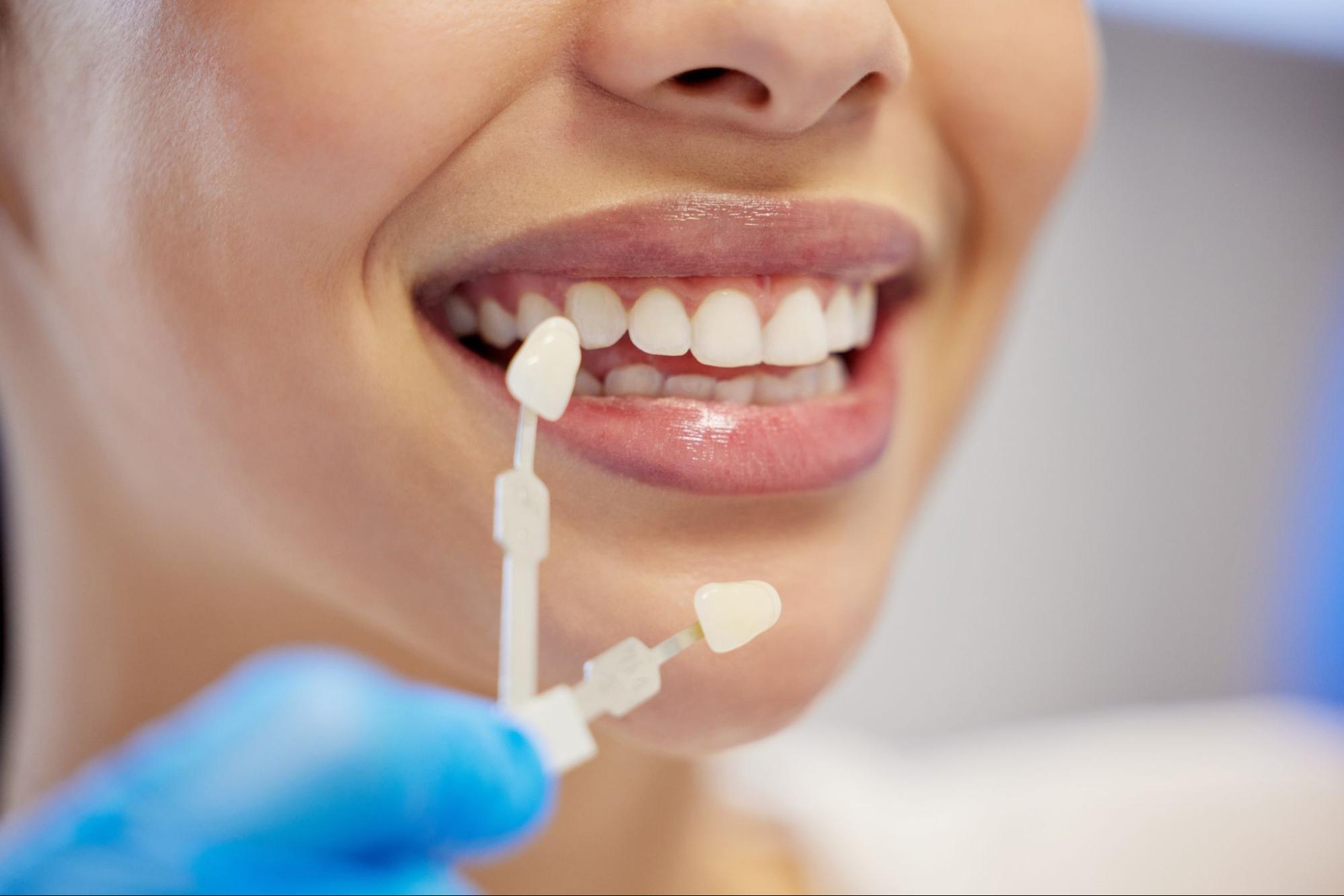 Close-up of a woman’s mouth with two veneer shade samples held near her teeth for color matching.