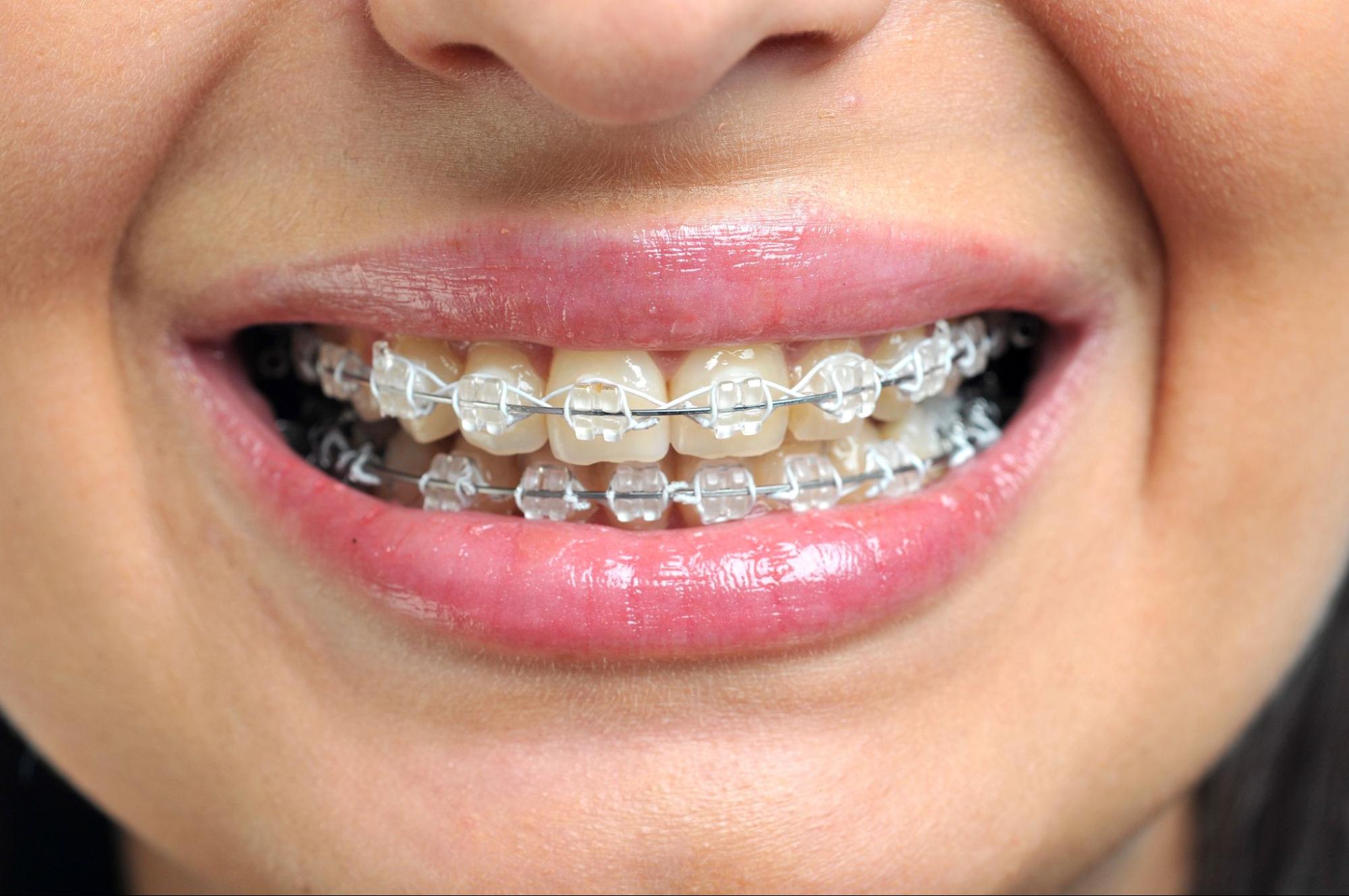 Mouth of a girl with clear braces.