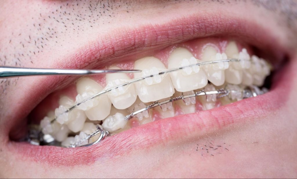 Close-up view of a probe inspecting teeth fitted with ceramic brackets.
