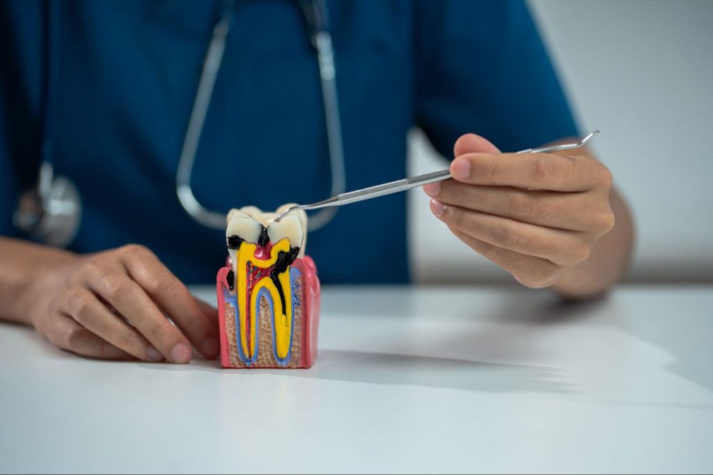 A cropped shot of a dentist showing root canal treatment on a decayed tooth model.