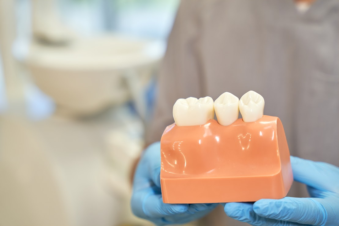 A dentist is holding a plastic mold of gums with three teeth.