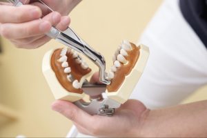 Hand demonstrating wisdom teeth removal using a dental model.