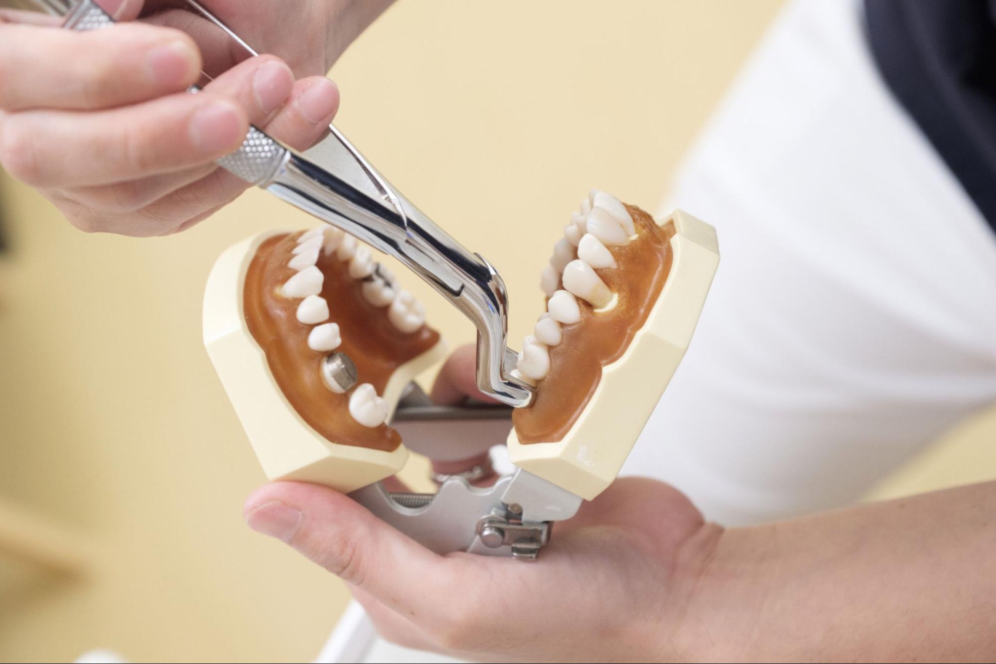 Hand demonstrating wisdom teeth removal using a dental model.